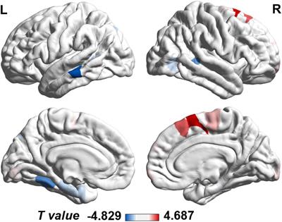 Bridging the Gap Between Morphometric Similarity Mapping and Gene Transcription in Alzheimer’s Disease